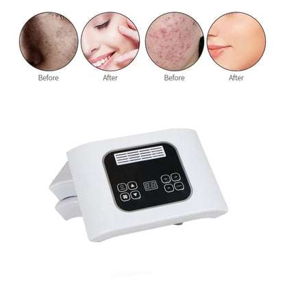 LED Photon Mask for Acne Treatment and Skin Rejuvenation